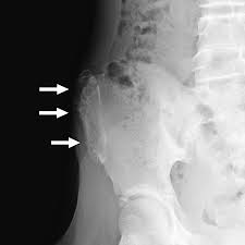 Image result for Hip Apophysitis