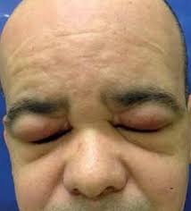 Chronic erythematous edema of the face; Morbihan Syndrome A Case Report And Literature Review Abstract Europe Pmc