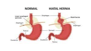 Hiatal hernia is caused by obesity, being pregnant, age, or thinning of the phrenoesophageal membrane. Hiatal Hernia Is It Related To Back Pain