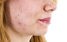 A scab is basically your body's way of protecting its self from infection. Healing Scabs On Your Face Lovetoknow