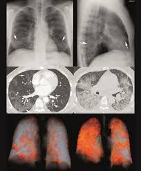 We did not find results for: Die Radiologische Diagnose Der Covid 19 Pneumonie Luzerner Kantonsspital