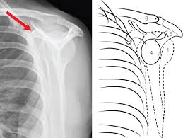 Image result for Shoulder XRay
