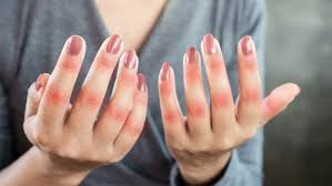 A health condition that lasts a long time, typically more than 3 months. Successful Treatment Of Patients With The Autoimmune Disease Lupus