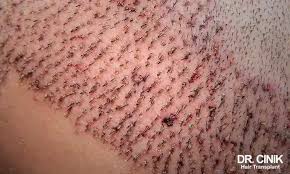 Image result for white scabs on the head in children