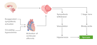 Image result for Exercise Induced Syncope