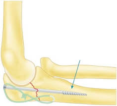Post the definition of olecranon to facebook share the definition of olecranon on twitter. Fractures Of The Olecranon And Complex Fracture Dislocations Of The Proximal Ulna And Radial Head Musculoskeletal Key