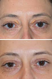Image result for xanthelasma of eyelid