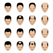 In going for a buzzcut or similar style, you're exposing your hairline fully and owning it. How To Make Your Hair Thicker Male Hair Loss Solutions Maxim Online