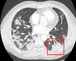 Right now, ct scans aren't routinely used to look for breast cancer, but may be used to look at chest, spine, or abdominal problems, such as a herniated disc or lung disease. Cureus Characteristics Of Chest Ct Images In Patients With Covid 19 Pneumonia In London Uk