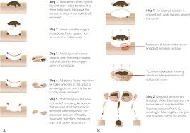 In cancer, cells divide and grow uncontrollably, forming malignant tumors, and invade nearby parts of the body. Understanding Mohs Micrographic Surgery Mayo Clinic Proceedings