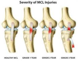 There is major pain, tenderness and swelling on the inner side of the knee. Common Questions About Mcl Knee Sprains Beacon Orthopaedics Sports Medicine