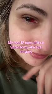 Just for reference this is what my eye looka like 12 days after a  vitrectomy. Im in no actual pain after eye surgery 👁️ #eyesurgery  #vitrectomyrecovery #eyesurgeryrecovery