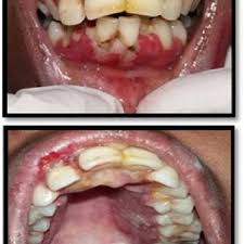 Herpes simplex virus two further conditions, seen especially in children, are herpetic gingivostomatitis and herpetic whitlow. Pdf Primary Herpetic Gingivostomatitis In An Adult Patient A Case Report