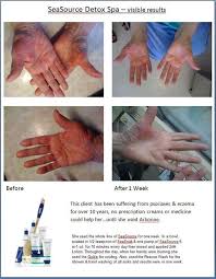 Do You Or Anyone You Know Suffer From Psoriasis Or Eczema Send Them My Way Arbonne Can Help Arbonne Psoriasis Detox Spa