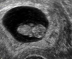 Eine schwangere, die raucht, sollte von ihrer umgebung wirklich. Ohne Rauchen Durch Die Schwangerschaft So Kann Es Klappen Www Frauenaerzte Im Netz De