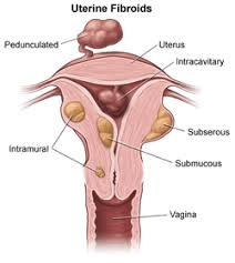 For degeneration of the endometrium in humans, see endometriosis. Fibroids What Are Fibroids Fibroids Symptoms Treatment Diagnosis Ucla