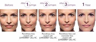Maybe you would like to learn more about one of these? Juvederm Ultra Lip Fillers In Grand Rapids Urban You Modern Beauty Wellness