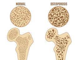 Osteoporosis – Symptoms, Risk Factors & Treatment | SingHealth