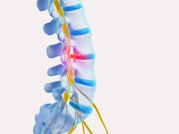 Der bandscheibenvorfall ist eine form der degenerativen wirbelsäulenerkrankung.durch degenerative veränderungen der zwischenwirbelscheibe und anliegenden strukturen (diskose, spondylose, bandscheibenprotrusion) kommt es zu einrissen des anulus fibrosus.dadurch wird ein vorfallen des gallertkerns (nucleus pulposus) der zwischenwirbelscheibe möglich. Bandscheibenvorfall Was Nun Hirslanden