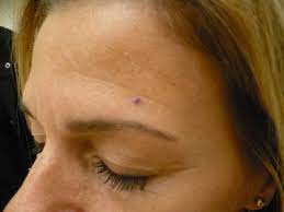 You will learn about how doctors describe a cancer's growth or spread. Pictures Of Skin Cancer Before After Mohs Surgery Jupiter Dermatology Hair Restoration