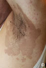 Image result for Erythrasma