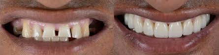 Maybe you would like to learn more about one of these? Dentures Before And After Pictures Of Patients European Denture Center