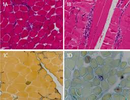 21 25 patients included in study proximal extremity cyclosporine a versus methotrexate in the treatment of polymyositis and dermatomyositis. Cureus Autoantibody Negative Immune Mediated Necrotizing Myopathy Responds To Early And Aggressive Treatment A Case Report