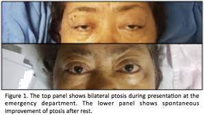 We did not find results for: Concurrent Myasthenia Gravis And Guillain Barre Syndrome In A 63 Year Old Female The First Case In The Philippines Journal Of The Neurological Sciences