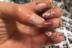 Take off acrylic nails remove acrylic nails acrylic nails at home acrylic tips acrylic nail removal simple nail designs beautiful nail designs perfect nails gorgeous nails. Woman Loses Thumb After Fake Nails Get Infected Metro News