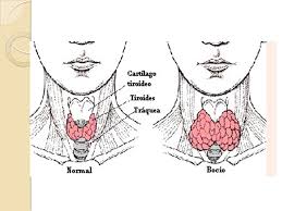 Bocio endémico difuso, revista cubana de medicina militar, 2008, volume 37, issue 3 La Tiroides Es Una Glandula En Forma De Mariposa Ubicada En El Cuello Justo Arriba De La Clavicula Por Debajo De La Laringe Y Esta Abrazada A La Ppt Video Online