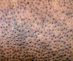 Image result for Keratosis pilaris