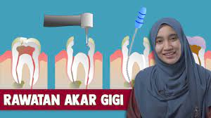 Perawatan yang tersedia untuk pasien seharusnya tergantung pada klasifikasi mereka ke dalam kelompok resiko. Rawatan Akar Gigi Youtube