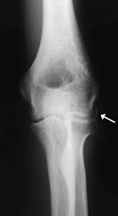 Obtain oblique view if suspicion high despite neg ap/lat. Avulsion Fracture Of The Medial And Lateral Epicondyles Of The Humerus Sciencedirect