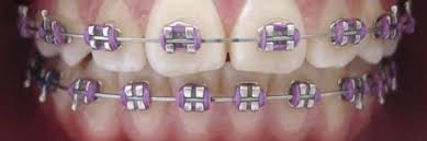 Dt Baddieswithbraces Blackbraces Bluebraces Boyswithbraces Bracesaesthetic Bracesap Cute Braces Colors Teeth Braces Dental Braces Colors