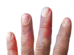 Image result for Chilblains