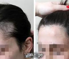 اضرار زراعة الشعر الطبيعي Behind Ear Tattoo Ear Tattoo Ear