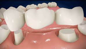 Maybe you would like to learn more about one of these? Dental Bridge Dan Kesehatan Gigi