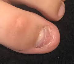 Image result for Onychotillomania feet
