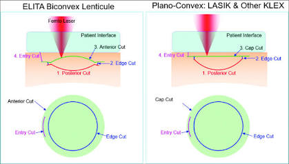 엘리타의 Bi-convex 디자인과 기존 Plano-convex 디자인 비교스마일라식차이