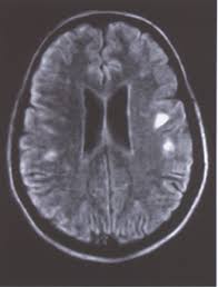 Image result for Optic Neuritis