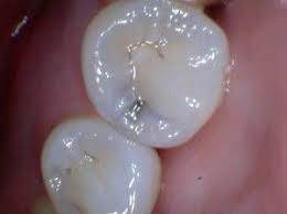 Carlsbad S Dentist Geoff Bell Blog Do These Stains In My Teeth Need Fillings Family Dentistry Stains Dentistry