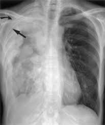 The most common findings on physical examination (79%) are signs of pleural effusion (eg, dullness to percussion, decreased breath. The Role Of Imaging In Malignant Pleural Mesothelioma Sciencedirect