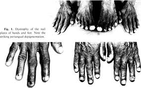 Image result for Onychotillomania feet