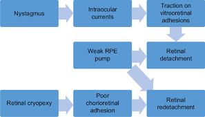 Flow Chart Of The Pathophysiology Of Retinal Detachment In