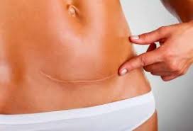C Section Scar Physiotherapy Treatment In London Women S Health Physio Rehabilitation For C Section Scars In London At Home Or At The Practices In Moorgate Ec2 Belgravia Sw1 Clapham Sw4 Axa Bupa