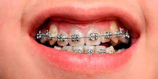 From gaps to overbites, to teeth or jaw alignment there are many factors that can a patient who carefully follows treatment instructions can increase the likelihood they get their braces off sooner. When Do You Get Your Braces Off Weber Orthodontics