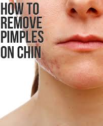 Chin Acne What Is It Causes And How To Get Rid Of It How To Remove Pimples Chin Acne Treatment Chin Acne