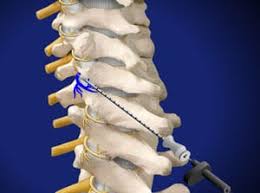 Image result for Lower Cervical Intramuscular Injection