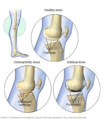 There is no set rule. Knee Replacement Mayo Clinic