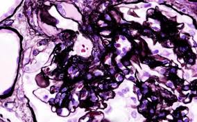 La urea es una sustancia secretada a nivel del hígado, producto del metabolismo proteico, a su vez, es eliminada a través de los riñones. Urea Baja En Sangre Hipoazoemia Que Significa Cuidatecv